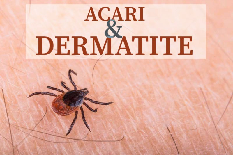 Acari e dermatite