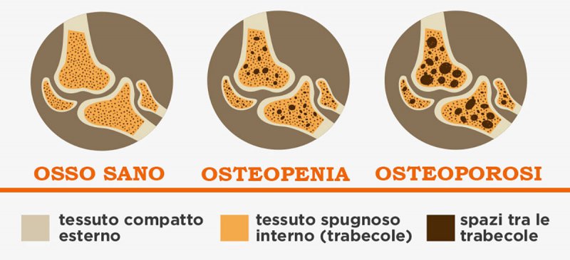 Osteoporosi