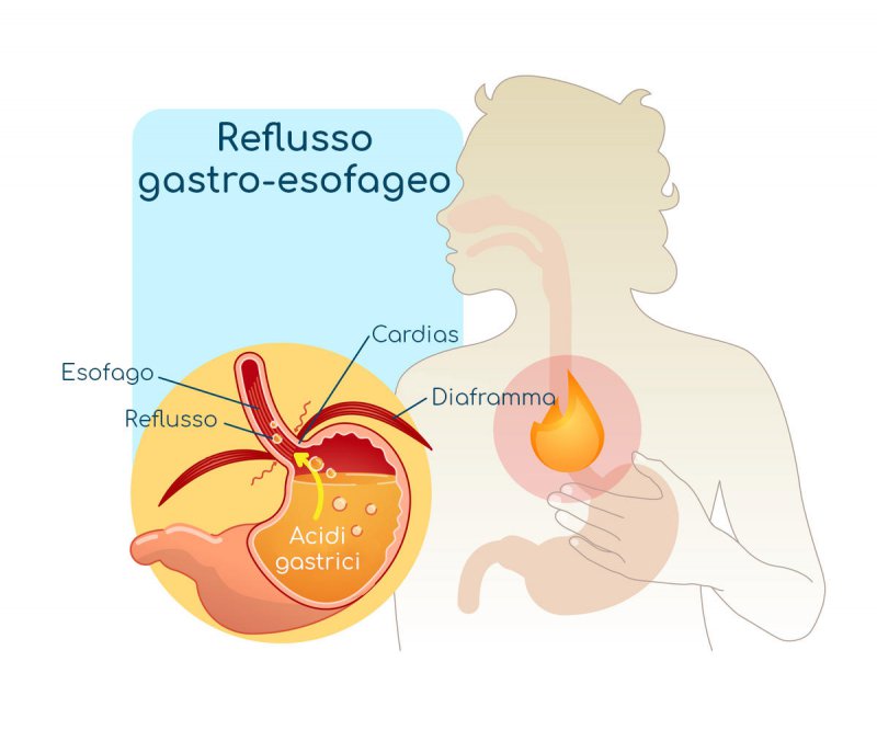 PEP-TEST Esame della saliva per REFLUSSO GASTRO-ESOFAGEO