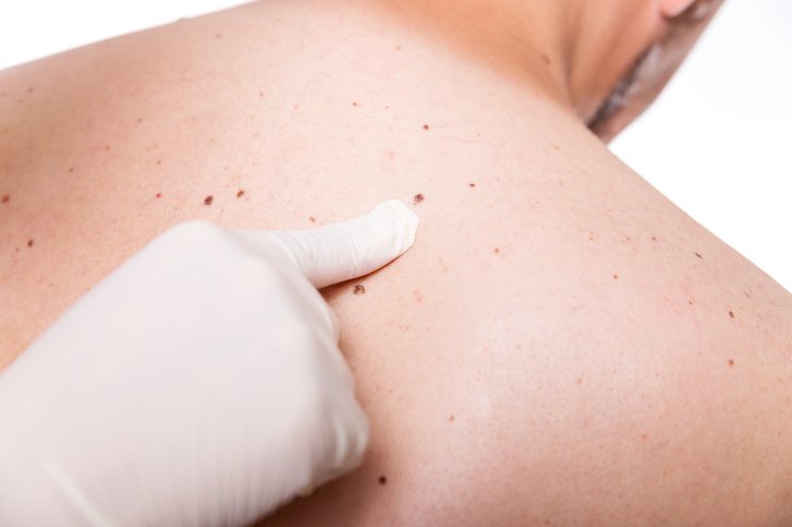 MELANOMA: fattori di rischio e cause