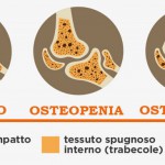 prevenzione-osteoporosi-emicenter-napoli-4-1.jpg