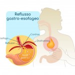 reflusso-gastroesofageo-1.jpg