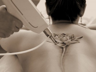 22 novembre Open day rimozione tatuaggi: consulto gratuito