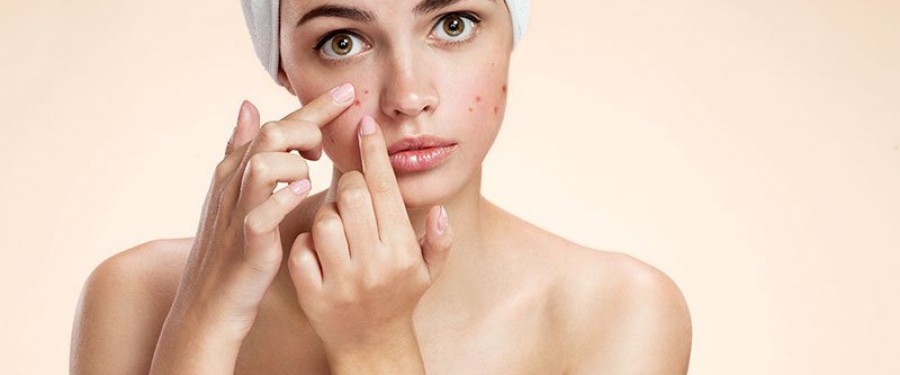 Problemi di acne? come curarli