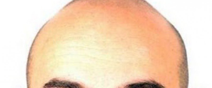 La calvizie ti sembra un problema irrisolvibile?