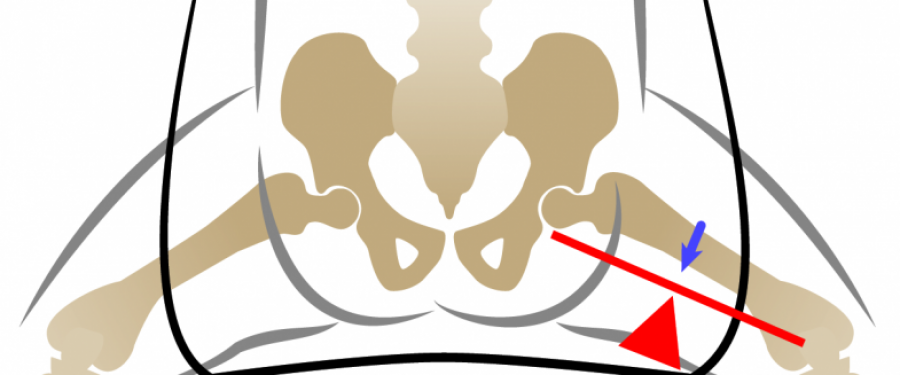 Displasia dell'anca: la terapia 