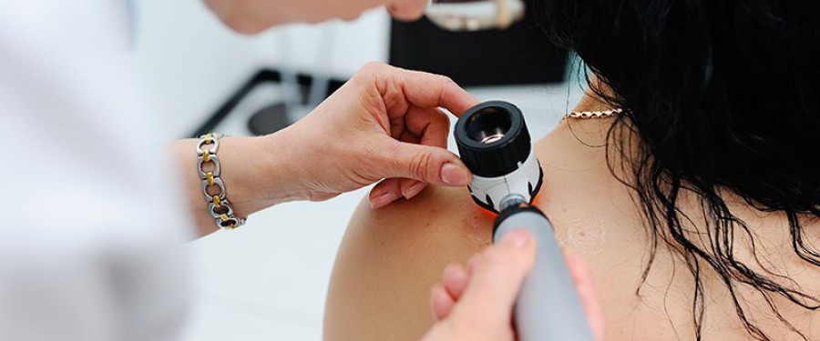 Il melanoma sintomi e cure