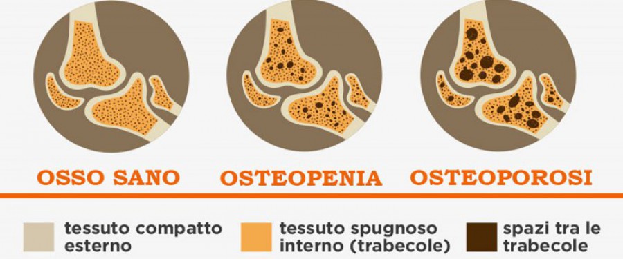 Osteoporosi