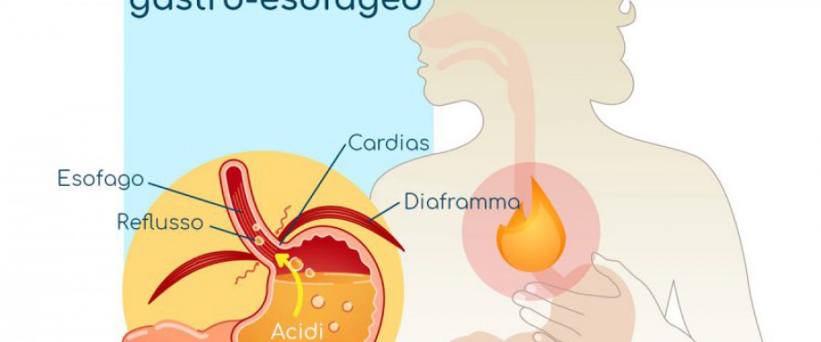 PEP-TEST Esame della saliva per REFLUSSO GASTRO-ESOFAGEO