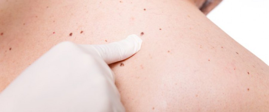 MELANOMA: fattori di rischio e cause